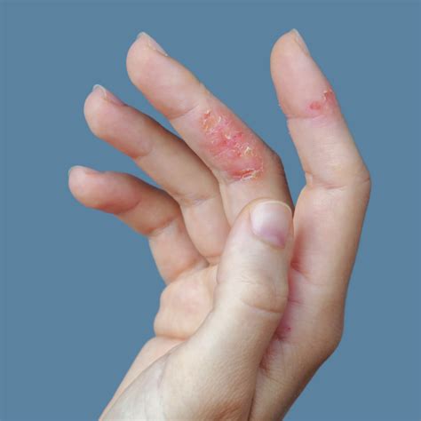 impact  atopic dermatitis   hands