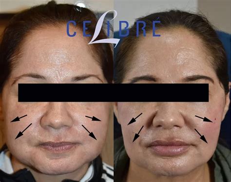 All About Jaw Slimming With Botox and Dysport