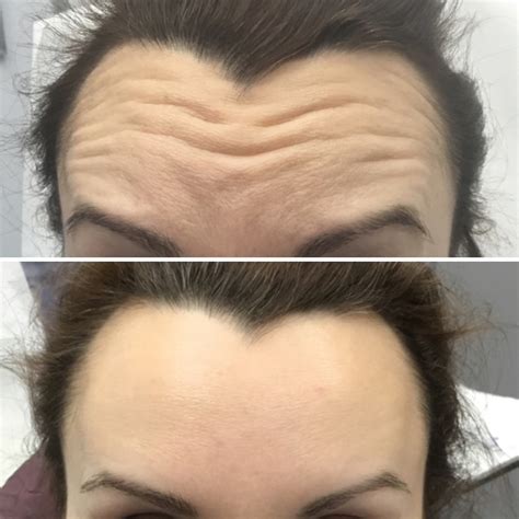Botox - Milani MedSpa