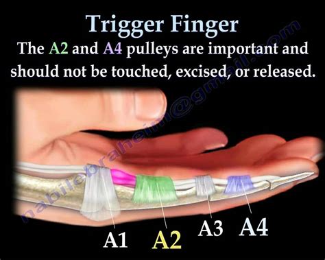 trigger finger  trigger thumb      dr