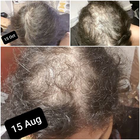 Telogen Effluvium: Signs, Treatment, and Recovery | Shuna Hammocks