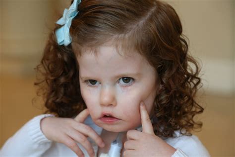 For Medical Professionals: Diagnosing Moebius Syndrome - Moebius