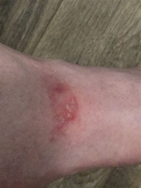 Does this look like the bite of a Brown Recluse or Black Widow