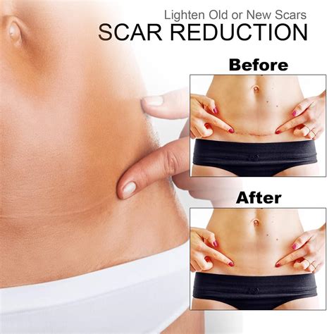 Medical Grade Silicone Scar Sheets Roll - Soft Easy-Tear & Reusable