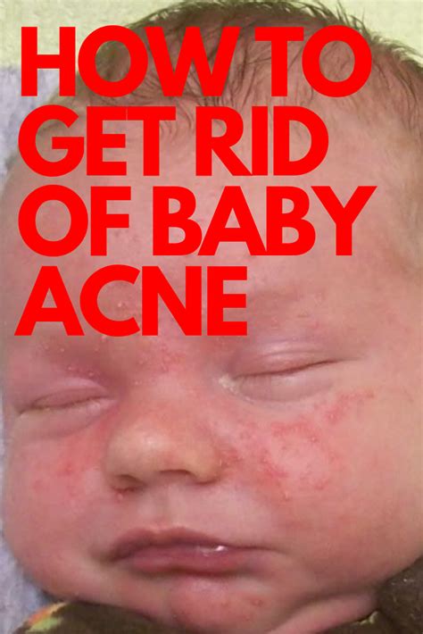 how to get rid of newborn acne