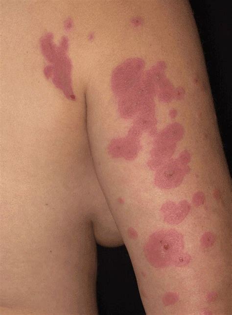 Quick Facts:Erythema Multiforme - Merck Manual Consumer Version