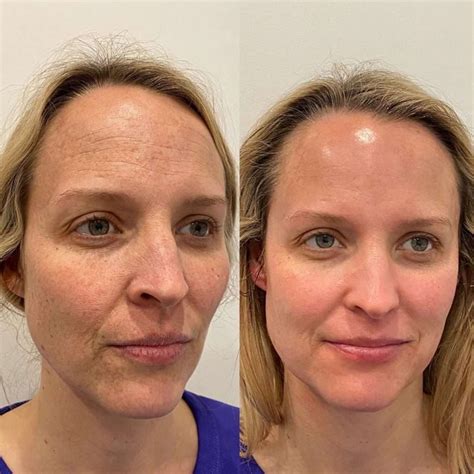 Терапии с Hydrafacial™ | Трайни и Видими Резултати | VDerm