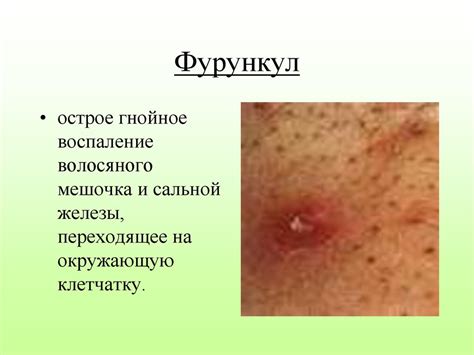 Первая помощь при ранениях, кровотечениях. (Лекция 10) - презентация онлайн