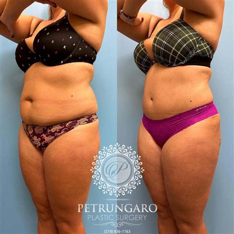 Platinum Tummy Tuck & Lipo 360 - Petrungaro Plastic Surgery