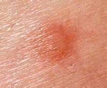 Flea Bites On Humans Pictures