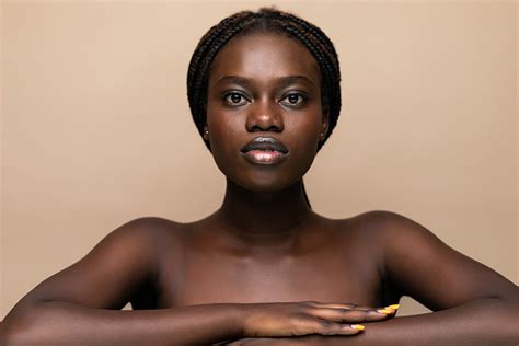 Post Inflammatory vs. Hyperpigmentation: What’s the Difference? | Urban ...
