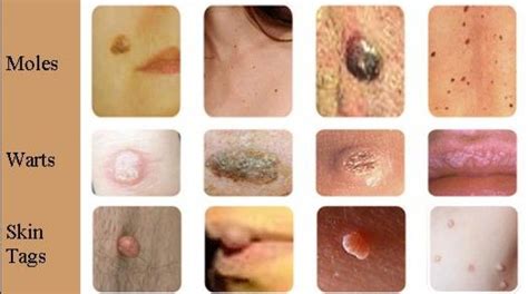 Skin Tag Vs Warts - update berita olahraga dalam luar