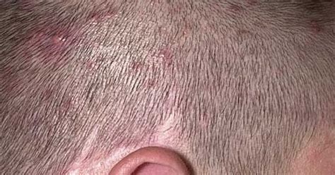 Scalp Folliculitis Treatment Using Organic Coconut Oil