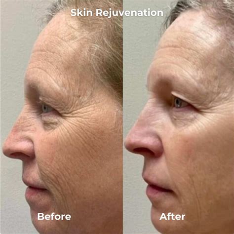 Radiofrequency Microneedling Before and After Photos - House of Beauty