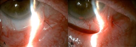 a, Infero-nasal symblepharon in the right eye (black arrow). b ...