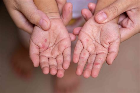 Hand, Foot, And Mouth Disease (HFMD): Signs and Symptoms