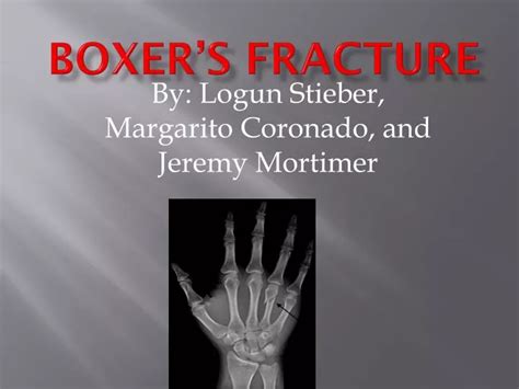 PPT - Boxer’s Fracture PowerPoint Presentation, free download - ID:2719970