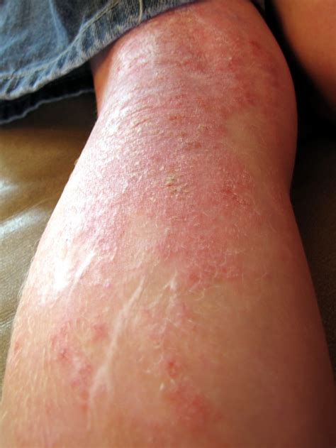 Eczema On Legs at Eliza Pethebridge blog
