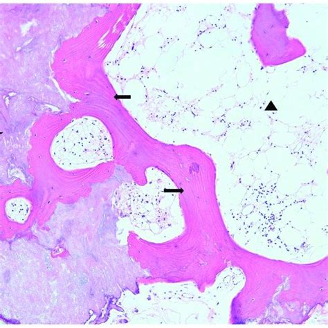 osseous metaplasia  mature bone formation   thyroid