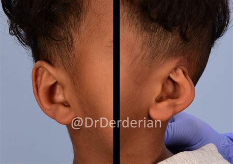 cryptotia dr derderian plastic  reconstructive surgery