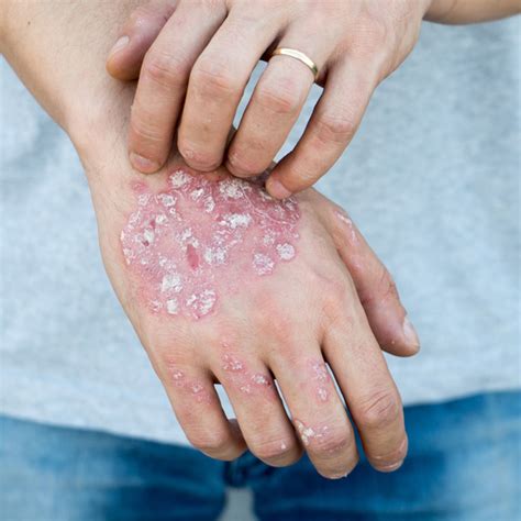 Plaque Psoriasis - Renstar Medical Research