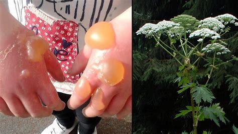 Giant Hogweed - A Flesh-Burning Plant Explained! - YouTube