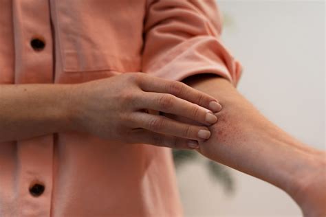 Fungal infection – Experia Advanced Skin & Hair Clinic