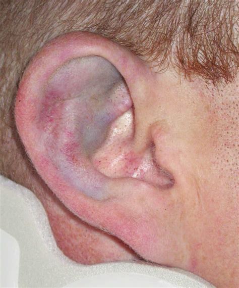 Contusion