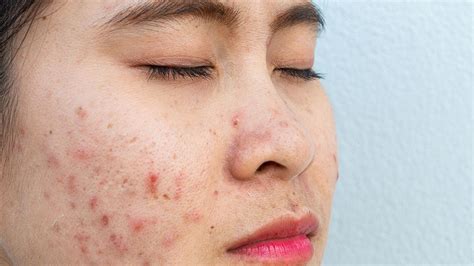 Macule Acne