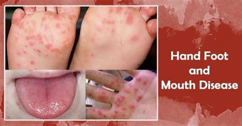 Hand Foot And Mouth Disease In Mouth