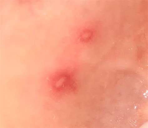 how to know a canker sore is healing