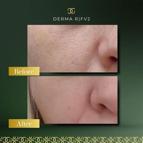 Derma Radio Frequency R|F V2 | Derma Group Ltd