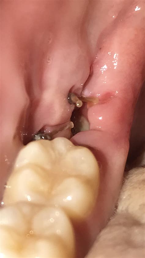 Wisdom Tooth Suture Fell Out at Neal Marquez blog