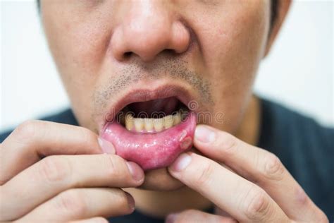 Pained Aphtha Ulcer at Mouth Stock Photo - Image of aphtae, macro ...