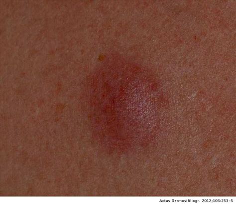 Linfoma folicular sistémico con afectación cutánea y recidiva ...