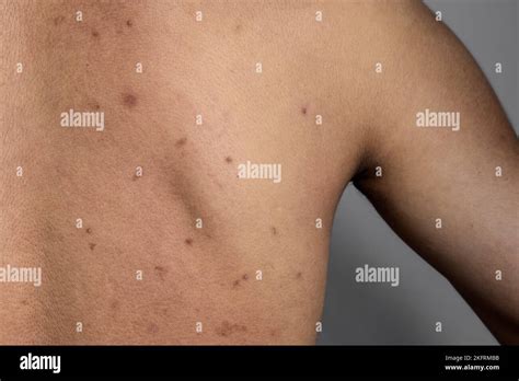 black spots pimples acne  scars     asian myanmar man