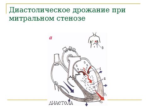 Синдромы недостаточности митрального клапана и стеноза левого ...