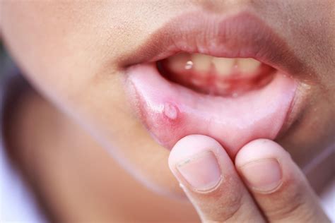 Mouth Ulcers Baby Mouth Ulcers Causes & Treatments | Colgate® IN