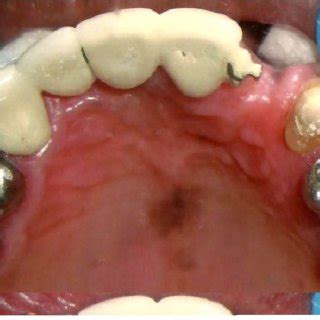 (A) Wax pattern fabricated over cast framework (B) entire cast ...