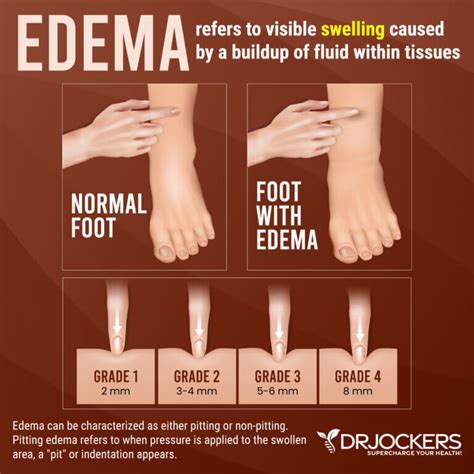 Edema: Symptoms, Causes, and Natural Support Strategies