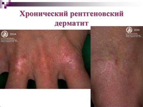 Аллергодерматозы. Дерматиты токсикодермии - презентация онлайн