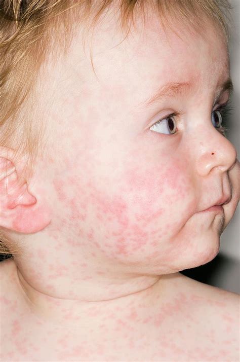 Measles Rash Photograph by Dr P. Marazzi/science Photo Library