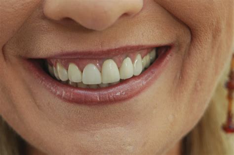 Gallery | Mountain Crest Dental Care | Dentist Orem, UT