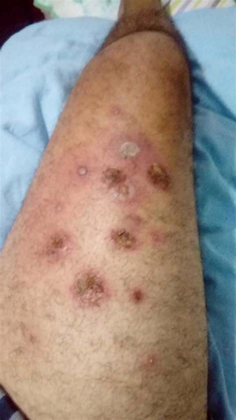 Early Pyoderma Gangrenosum