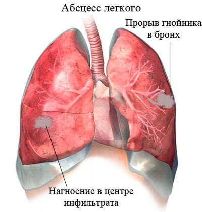 Абсцес легені: 4 основних причини, 11 провідних симптомів, 3 методу ...