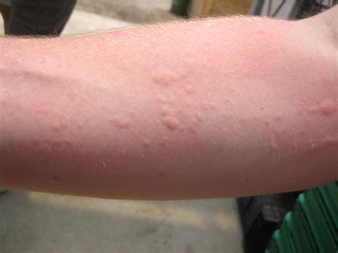 Bed Bug Rash