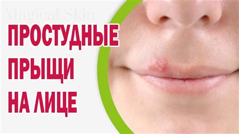 Простудные прыщи на лице: лечение, средства, профилактика - YouTube