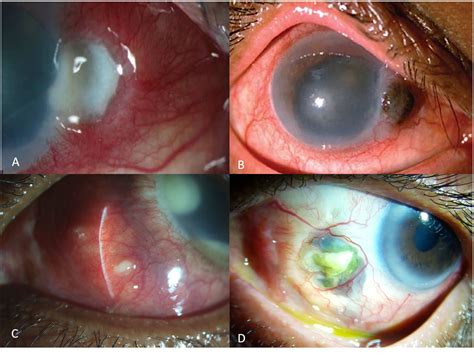 Frontiers | Infectious scleritis: a review of etiologies, clinical