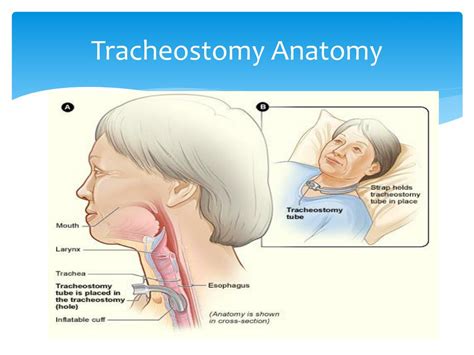 PPT - Tracheostomy Care PowerPoint Presentation, free download - ID:5705059