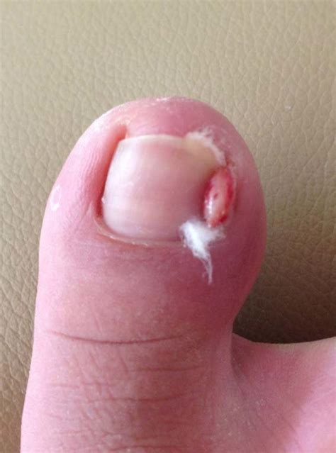 FIG URE 2 Cotton wisps under the ingrown nail edge with granulation ...